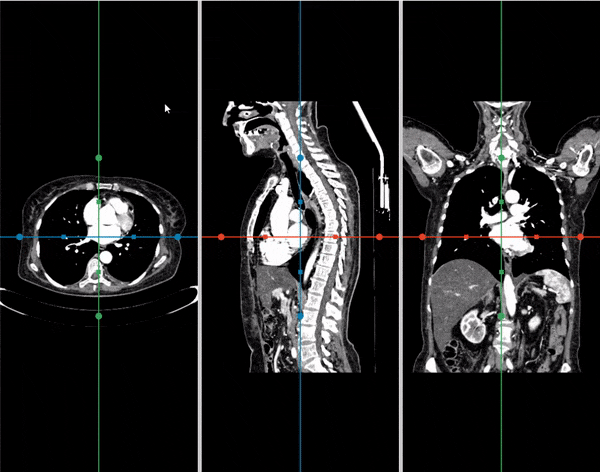 DICOM Vision zero-footprint viewer – Multi-Planar Reconstruction MPR of CT scan